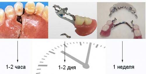 Клей для ремонта зубных протезов из пластмассы. Средства для склеивания зубных протезов в домашних условиях