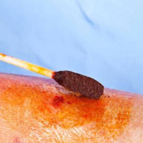 Какие симптомы указывают на ожог от йода. Ожоги йодом: причины, симптомы, лечение