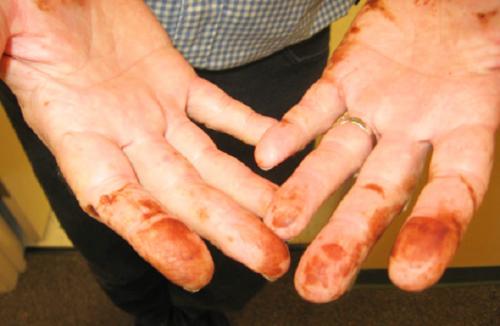 Как убрать йод с кожи рук. 7 проверенных способов, чем быстро отмыть йод с кожи рук.