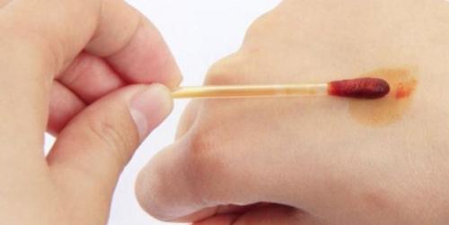 Что такое ожог от йода и почему он возникает. Ожоги йодом: причины, симптомы, лечение