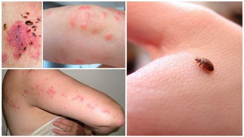 Как предотвратить повторное появление постельных клещей в квартире. Симптомы укусов бельевых клещей