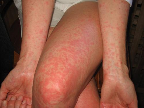 Как определить, есть ли клещи домашней пыли в вашем доме. Особенности пылевых клещей