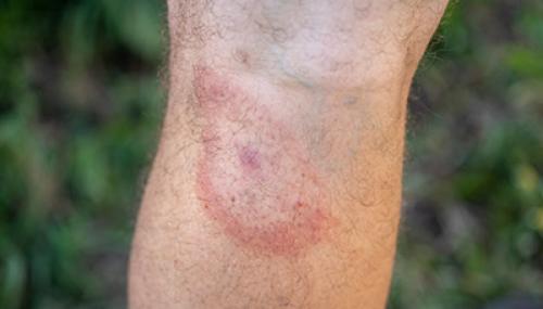 Полное руководство: как эффективно избавиться от клещей в волосах 07