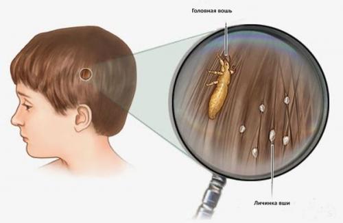 Полное руководство: как эффективно избавиться от клещей в волосах 01