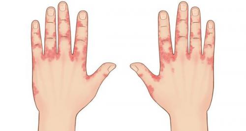 Монтажная пена на коже рук: что делать и как убрать 07 Монтажная пена на коже рук: что делать и как убрать 07