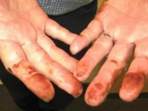 Чем отмыть йод с рук. Устраняем пятна йода быстро и без проблем