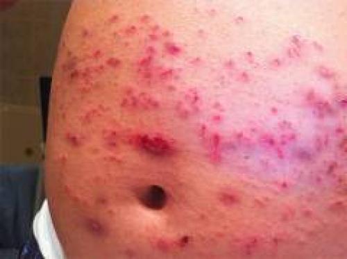 Как избавиться от платяных вшей. Платяной педикулез: признаки, меры санации и профилактики 02