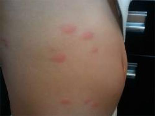 Как избавиться от платяных вшей. Платяной педикулез: признаки, меры санации и профилактики 01