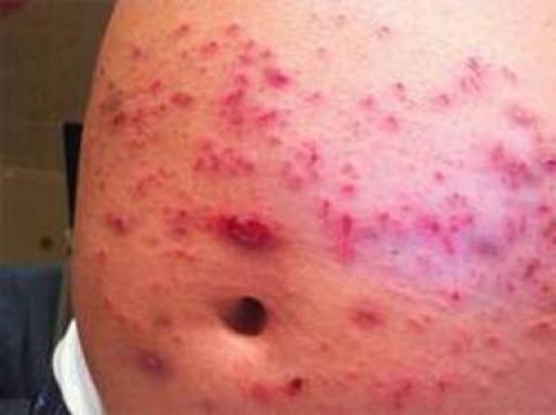 Бельевые вши, как обнаружить. Определение болезни. Причины заболевания 05 Бельевые вши, как обнаружить. Определение болезни. Причины заболевания 05